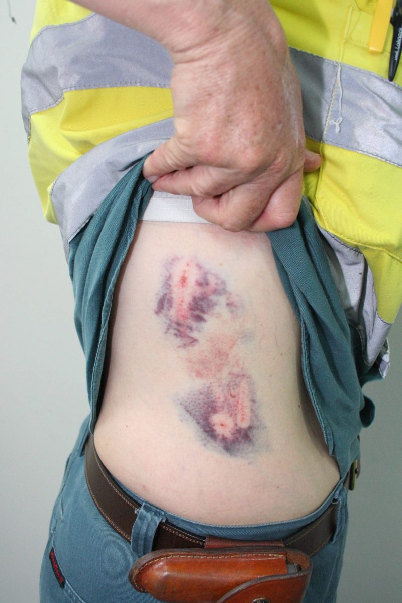 Dog bite victim shows injuries to the side.